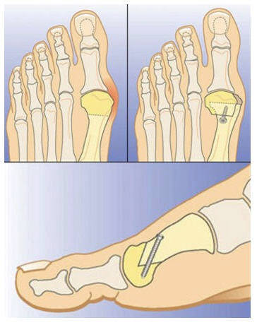 Hallux v5